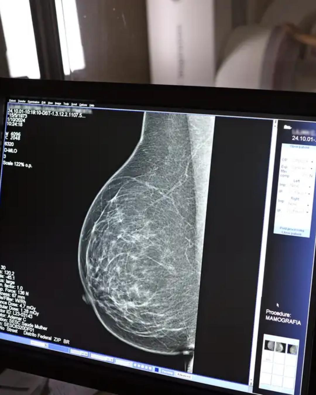 Desigualdade no acesso a mamógrafos desafia prevenção do câncer de mama no Brasil