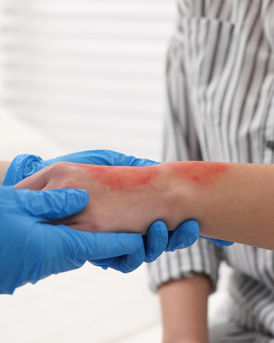 Paraná registra aumento de queimaduras no verão e orienta cuidados com fogos de artifício e exposição solar