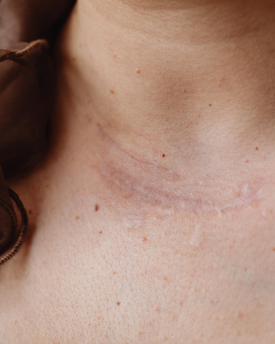 Paraná registra mais de 5 mil novos casos e 400 mortes por câncer de pele anualmente, aponta INCA