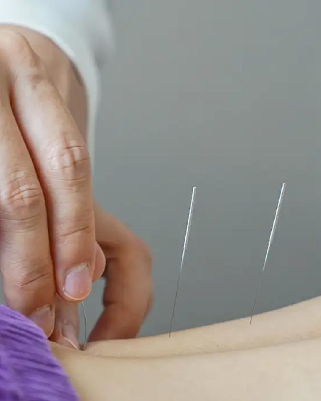 Lula sanciona lei que regulamenta profissão de acupunturista no Brasil