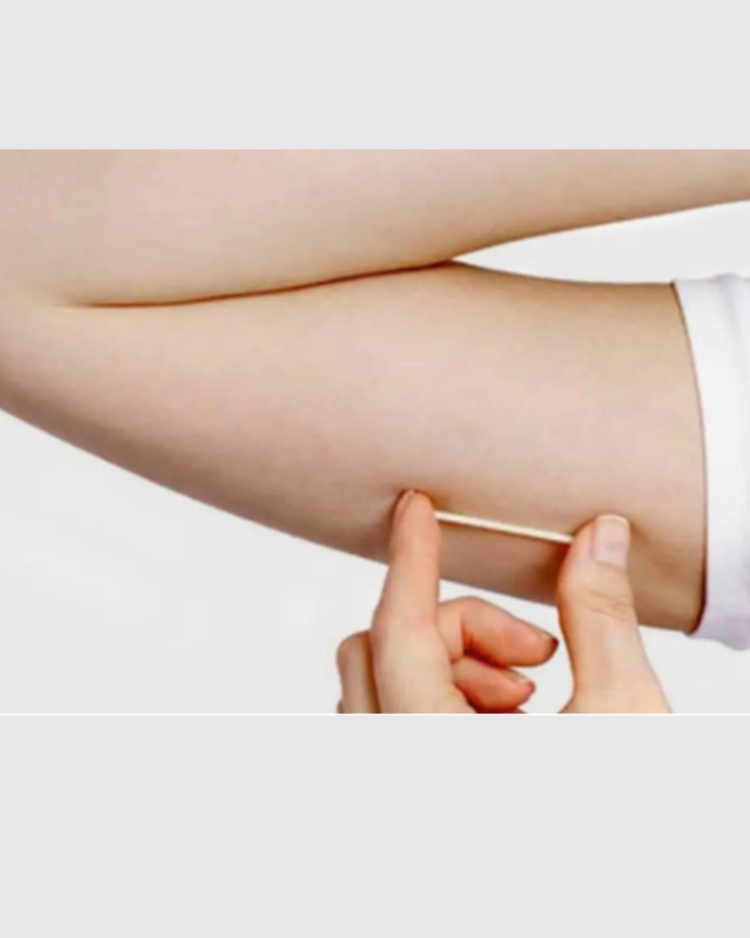 Colombo disponibiliza implante contraceptivo de longa duração pelo SUS