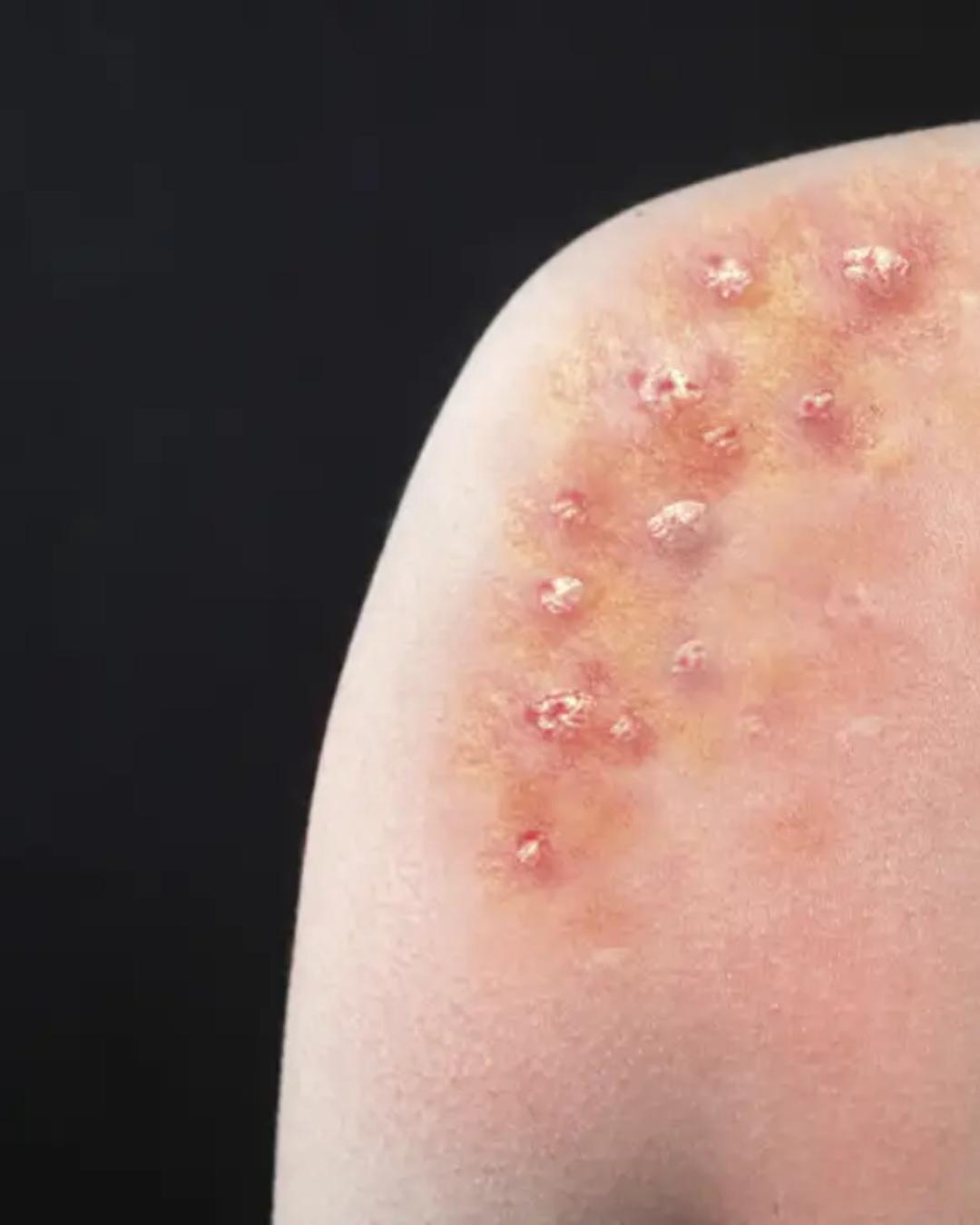 Porto Alegre registra novo caso de Mpox e reforça orientações pré-Carnaval