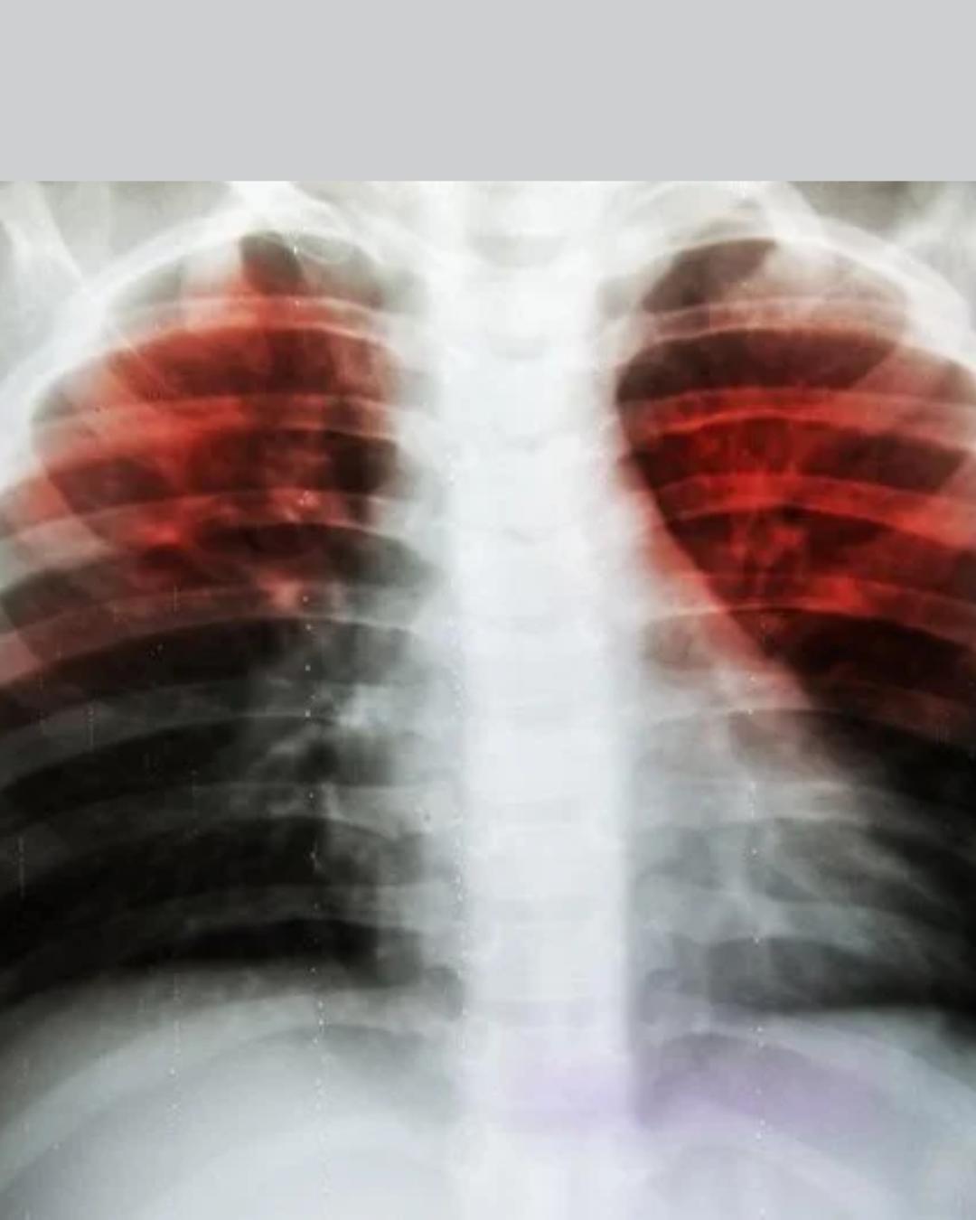 Brasil e Paraná registram aumento de casos e mortes por tuberculose na última década