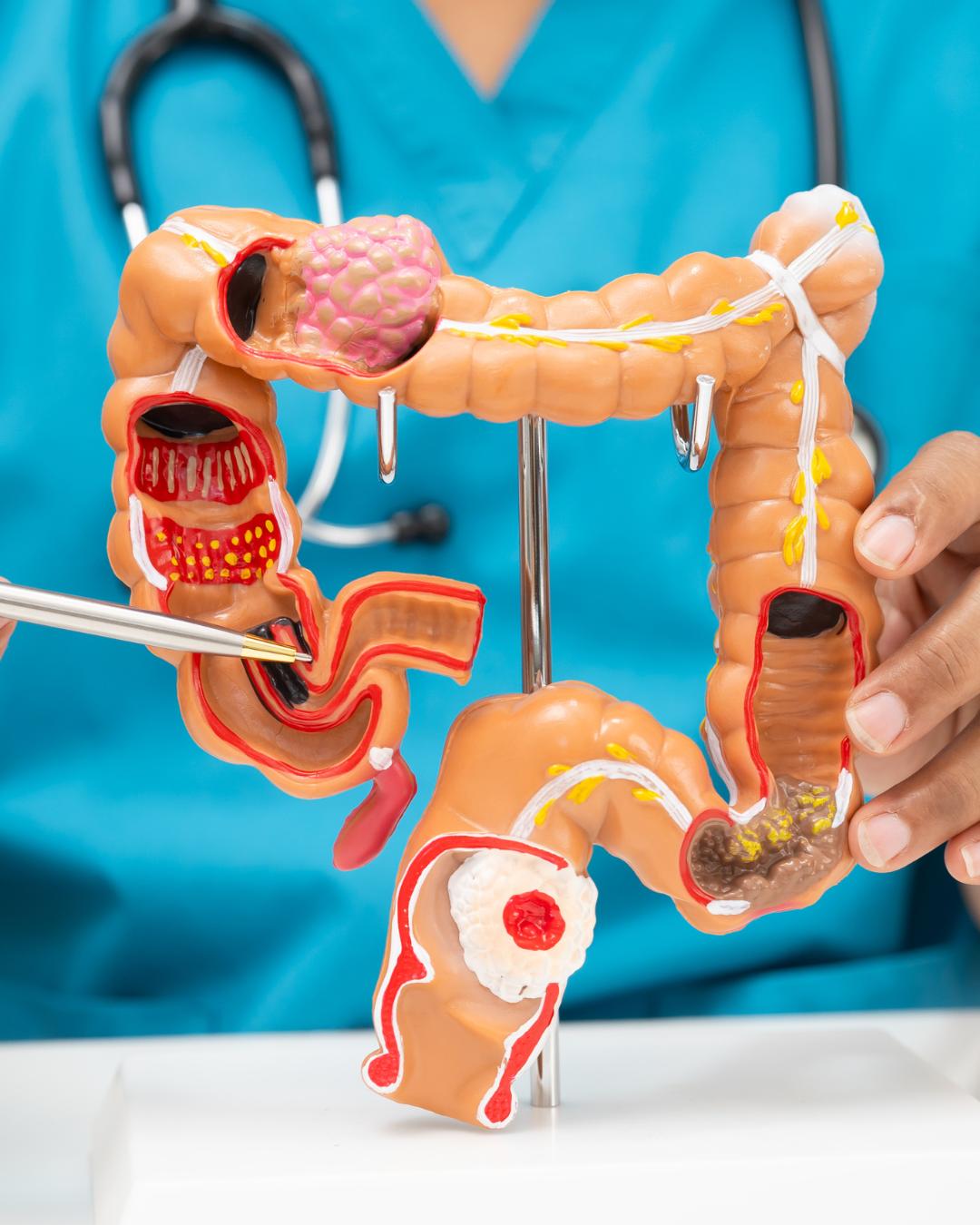 Câncer de intestino avança no Brasil e sinais iniciais ainda são ignorados pela população