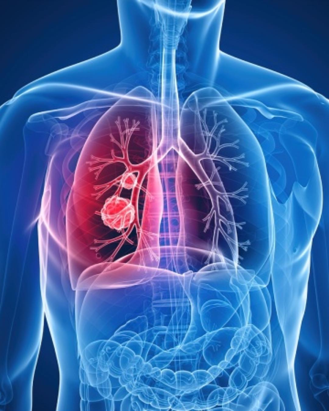 Entenda o que é o adenocarcinoma pulmonar, diagnóstico recente do Papa Leão XIV